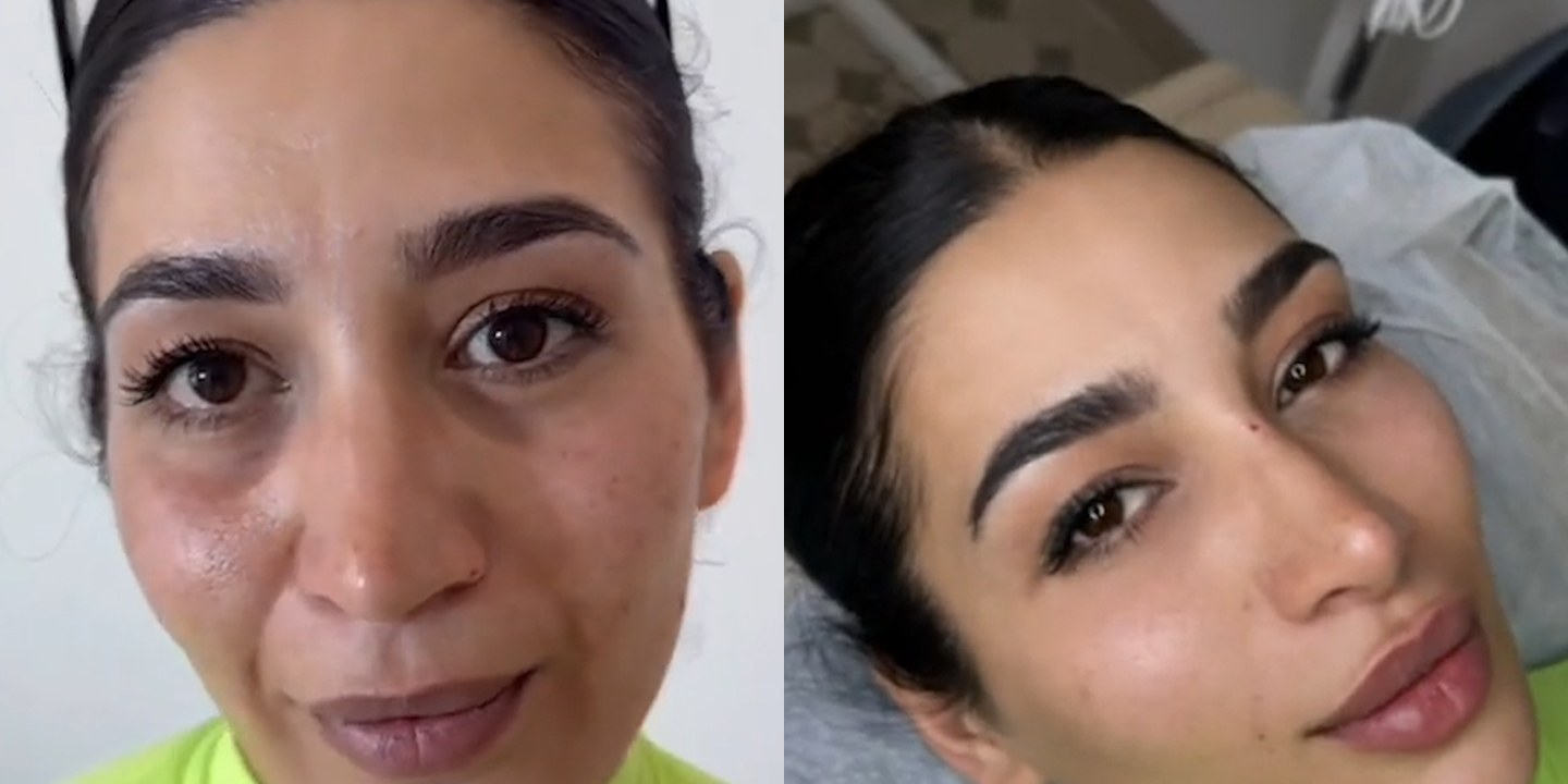 Antes e depois rejuvenescimento caso 52