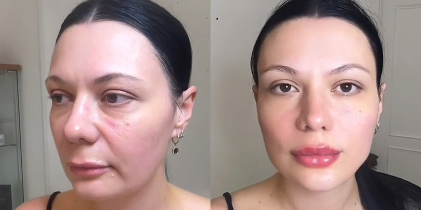 Antes e depois rejuvenescimento caso 53