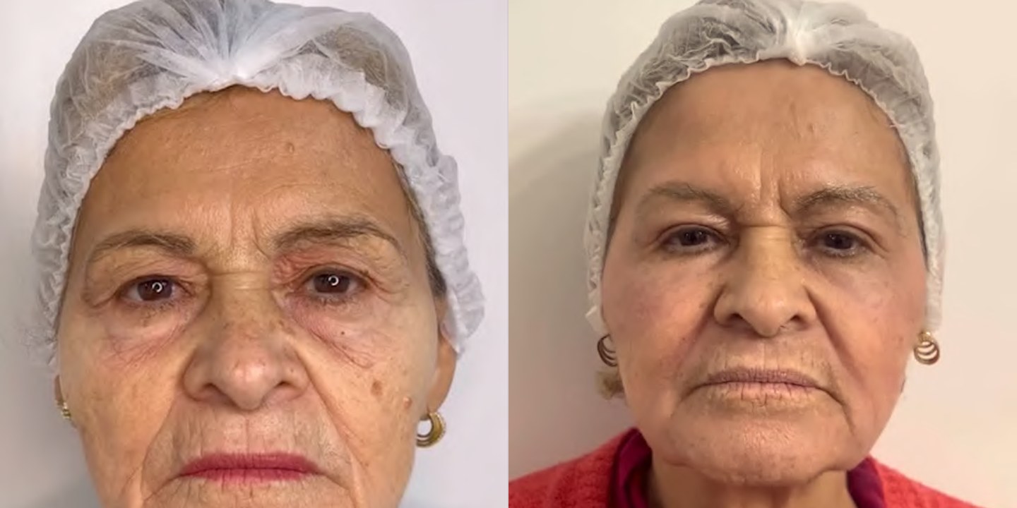 Antes e depois rejuvenescimento caso 06