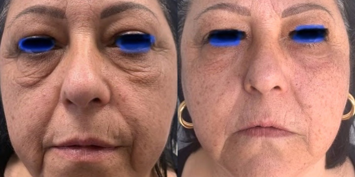 Antes e depois rejuvenescimento caso 07