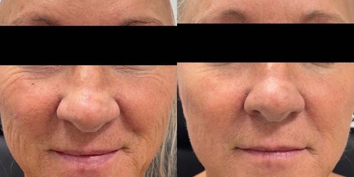Antes e depois rejuvenescimento caso 08