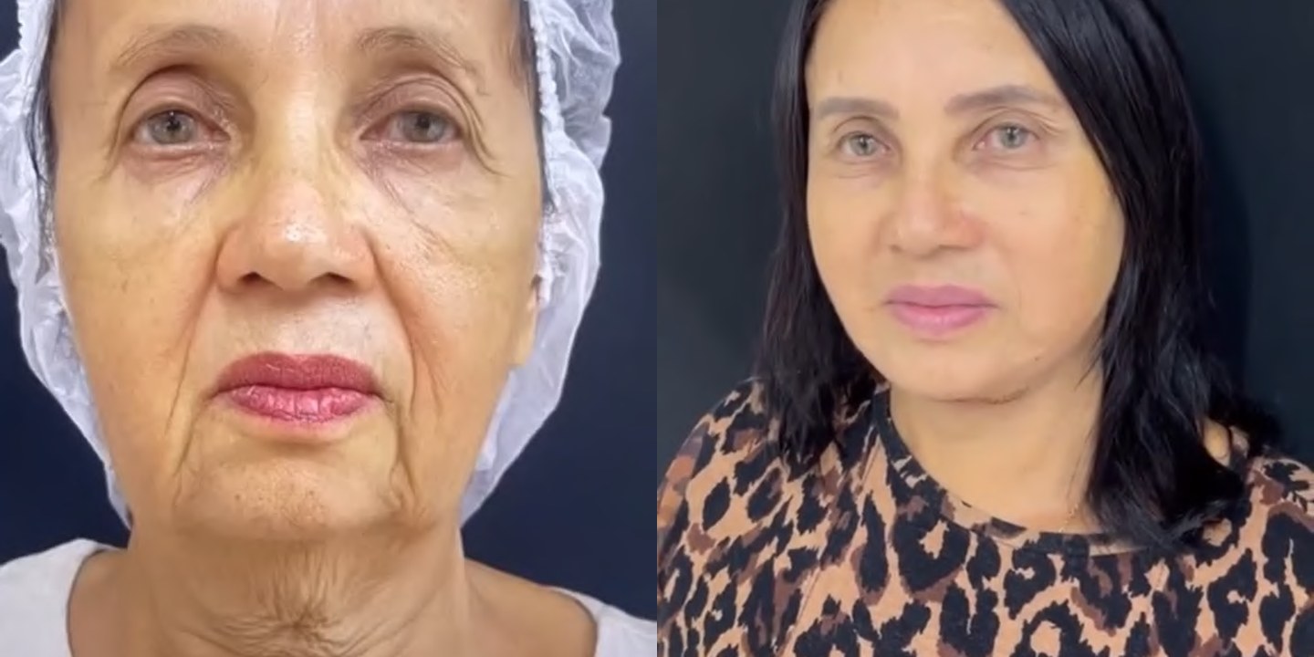 Antes e depois rejuvenescimento caso 09