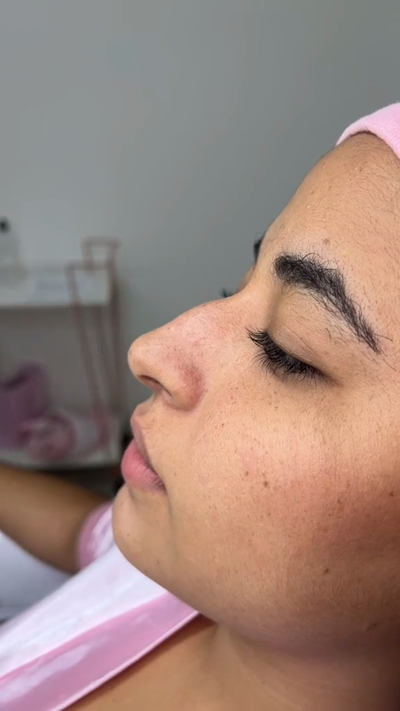 Antes - Rinomodelação - Est&eacute;tica Batel Curitiba