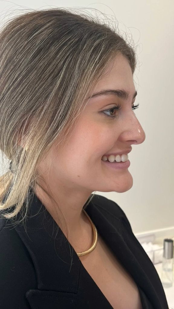 Antes - Rinomodelação - Est&eacute;tica Batel Curitiba