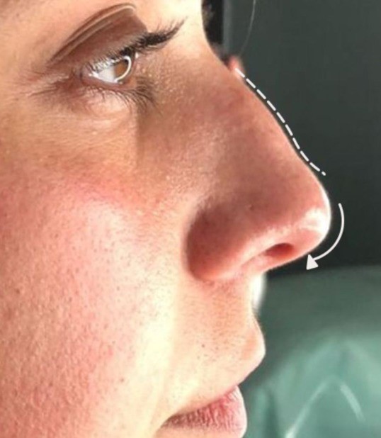 Antes - Rinomodelação - Est&eacute;tica Batel Curitiba