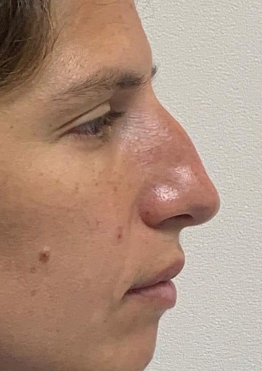 Antes - Rinomodelação - Est&eacute;tica Batel Curitiba