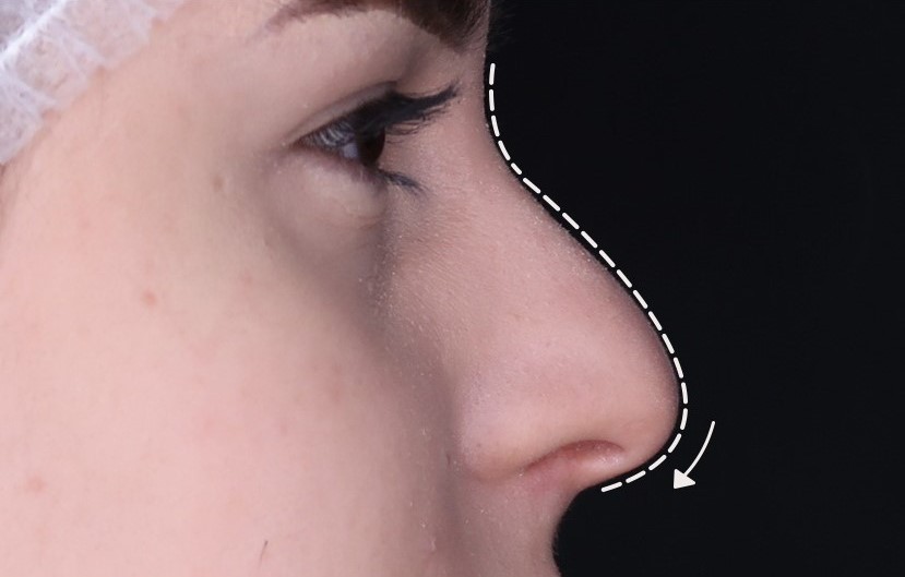 Antes - Rinomodelação - Est&eacute;tica Batel Curitiba