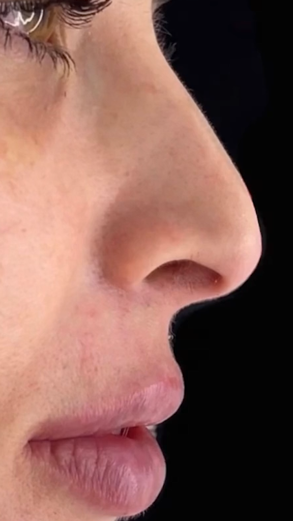 Antes - Rinomodelação - Est&eacute;tica Batel Curitiba