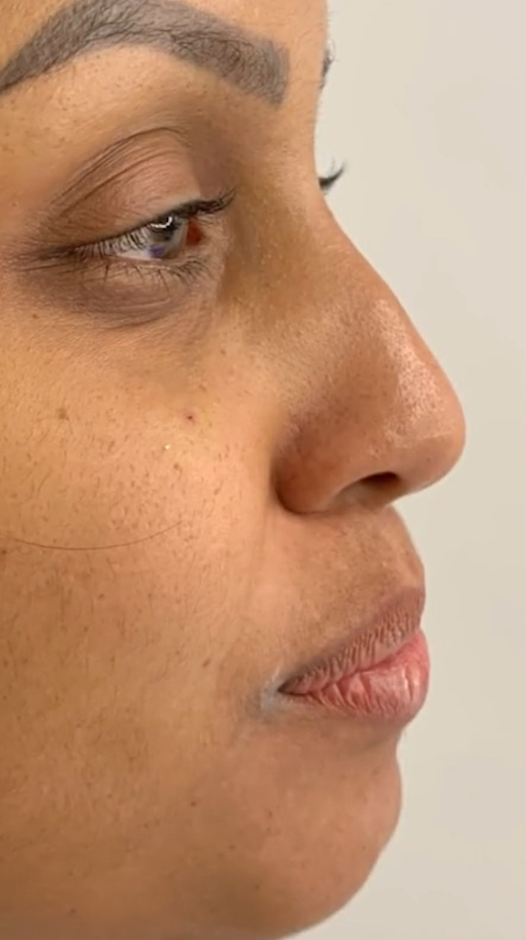 Antes - Rinomodelação - Est&eacute;tica Batel Curitiba
