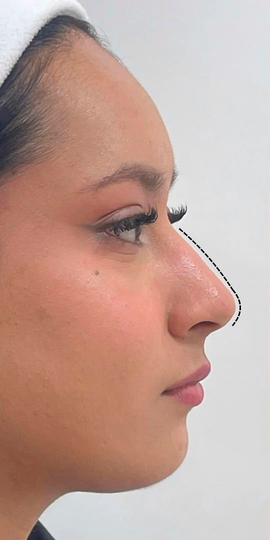 Antes - Rinomodelação - Est&eacute;tica Batel Curitiba