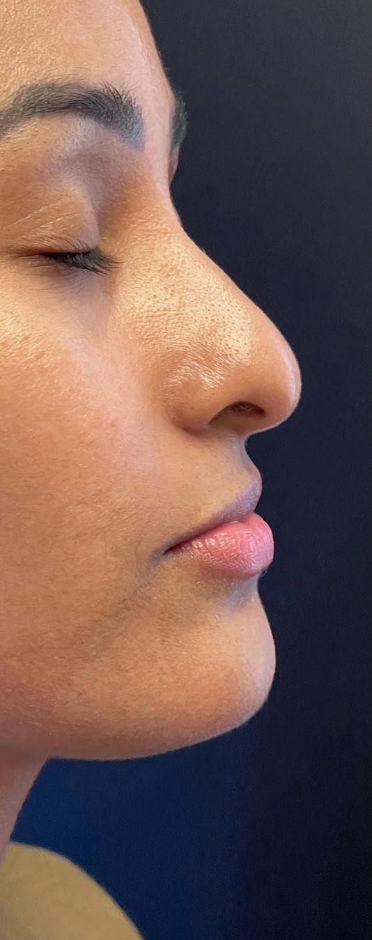 Antes - Rinomodelação - Est&eacute;tica Batel Curitiba