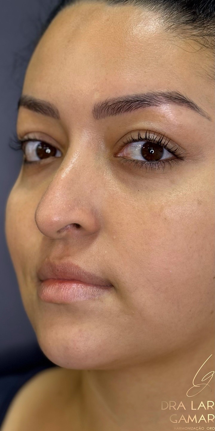 Antes - Rinomodelação - Est&eacute;tica Batel Curitiba