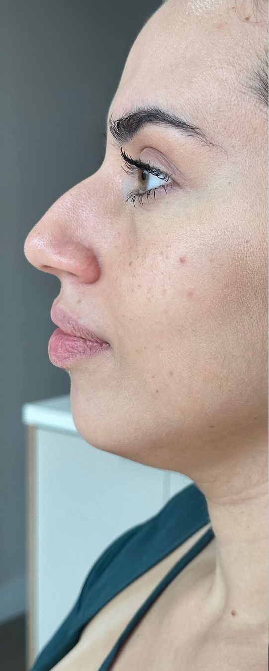 Antes - Rinomodelação - Est&eacute;tica Batel Curitiba