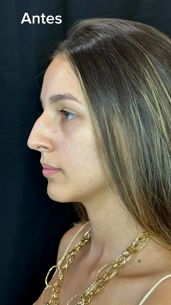 Antes - Rinomodelação - Est&eacute;tica Batel Curitiba