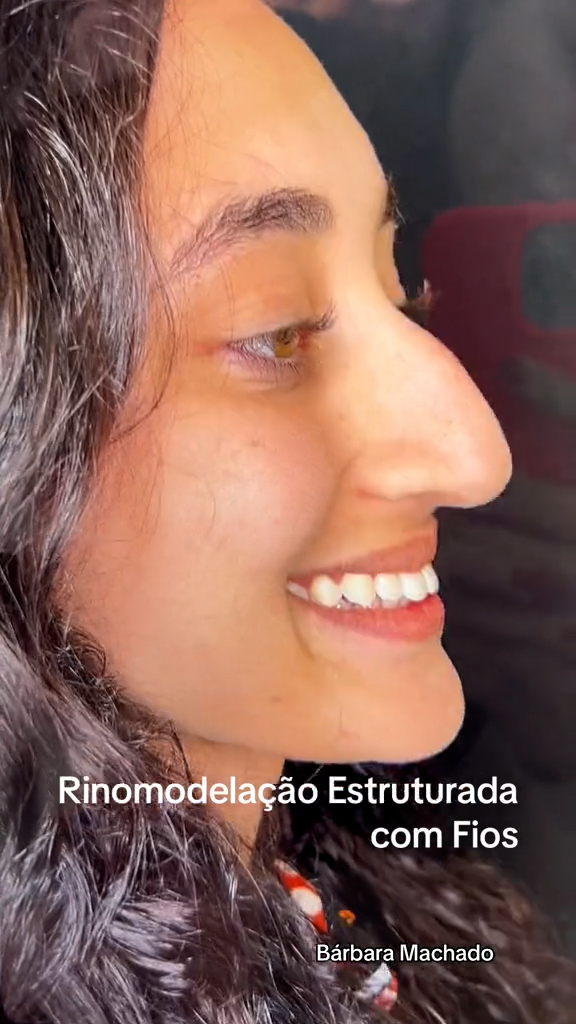Antes - Rinomodelação - Est&eacute;tica Batel Curitiba