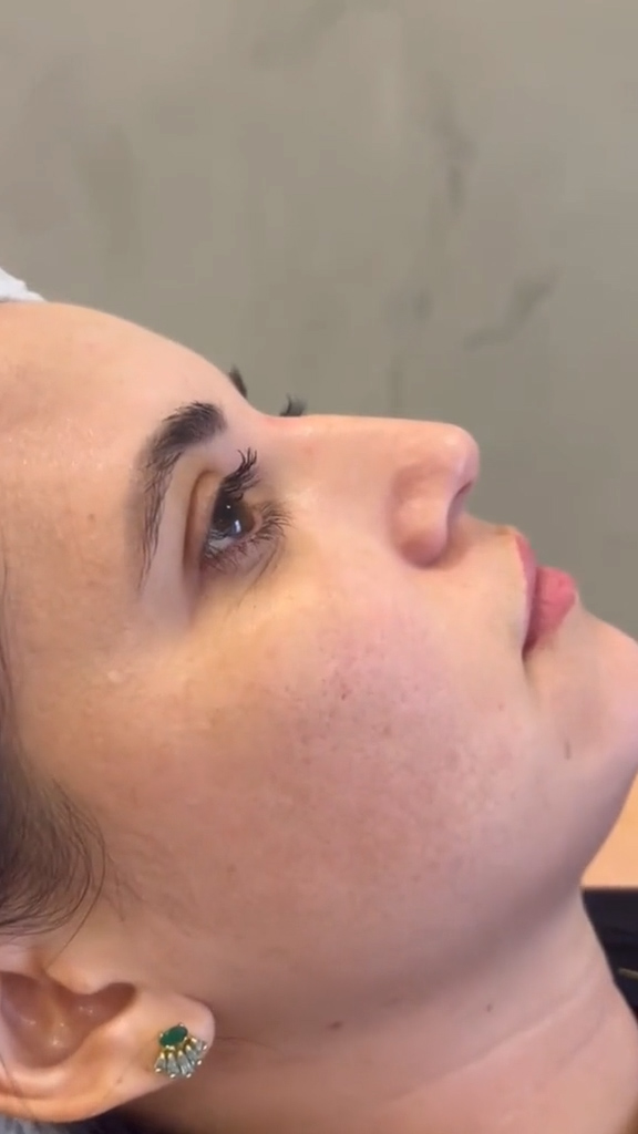 Antes - Rinomodelação - Est&eacute;tica Batel Curitiba