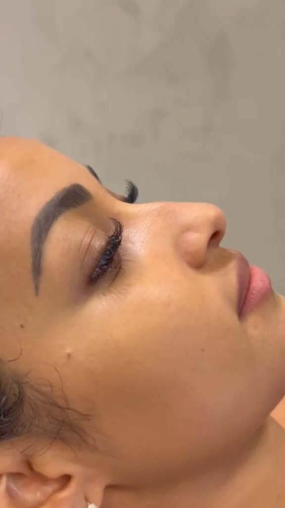 Antes - Rinomodelação - Est&eacute;tica Batel Curitiba