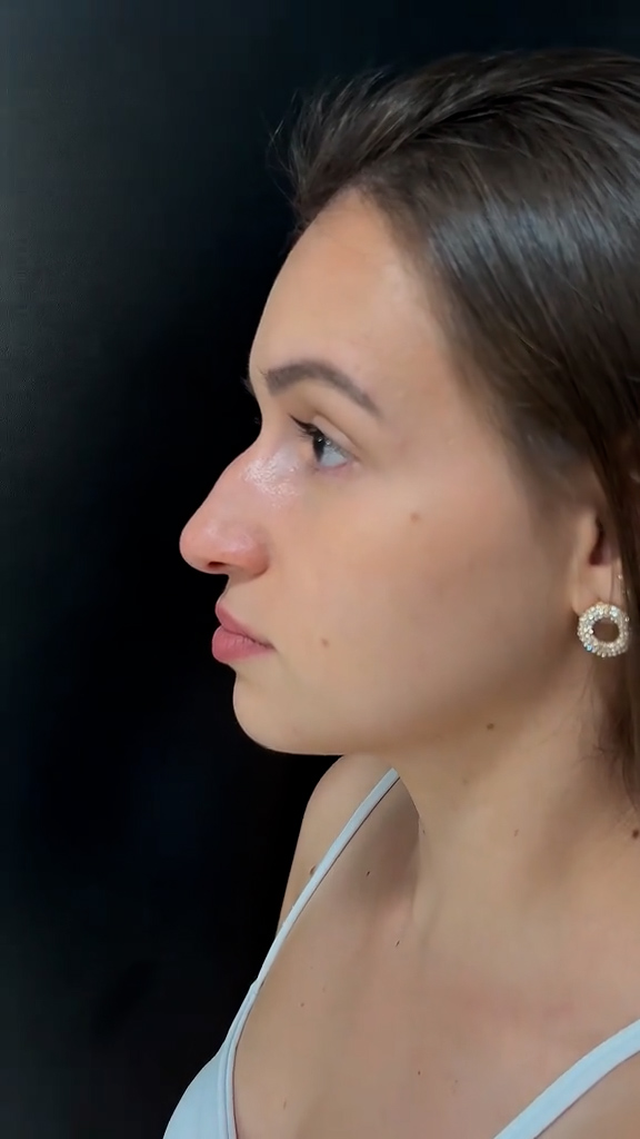 Antes - Rinomodelação - Est&eacute;tica Batel Curitiba