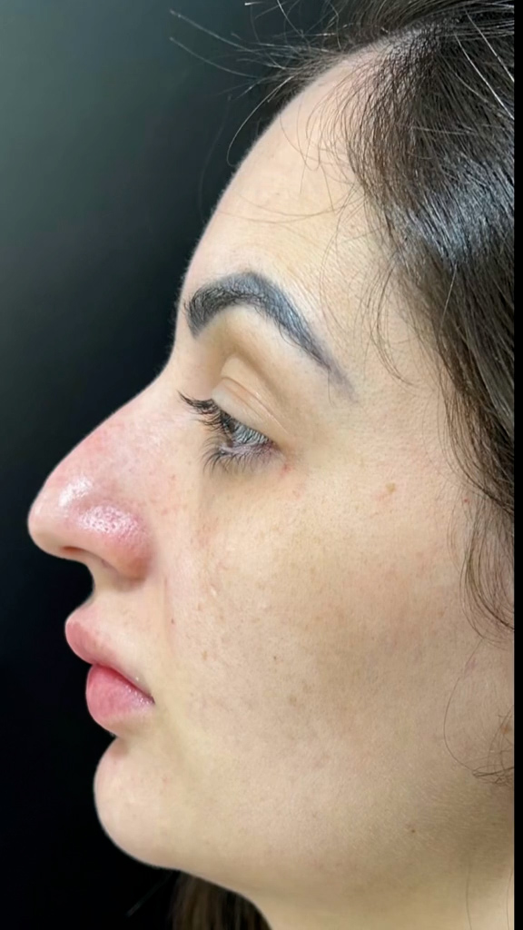 Antes - Rinomodelação - Est&eacute;tica Batel Curitiba