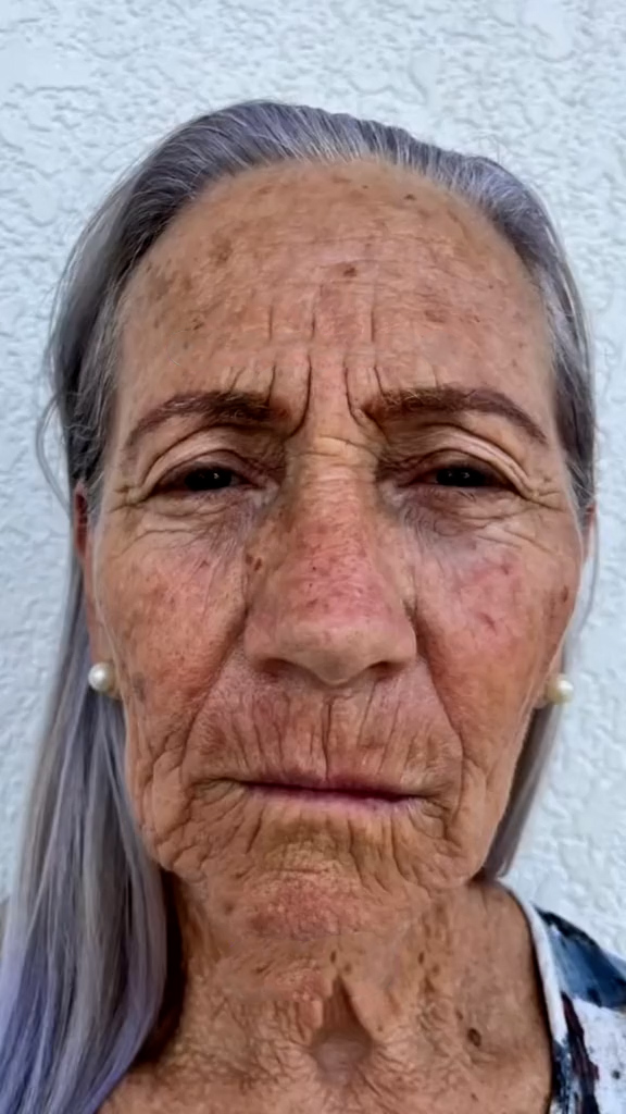 Antes - Toxina Botulínica caso 131